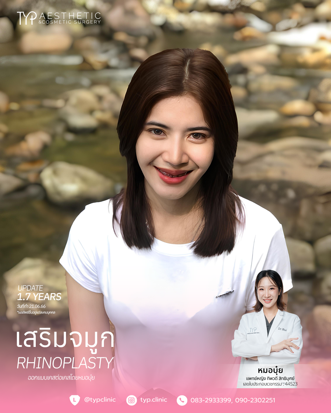 เสริมจมูก