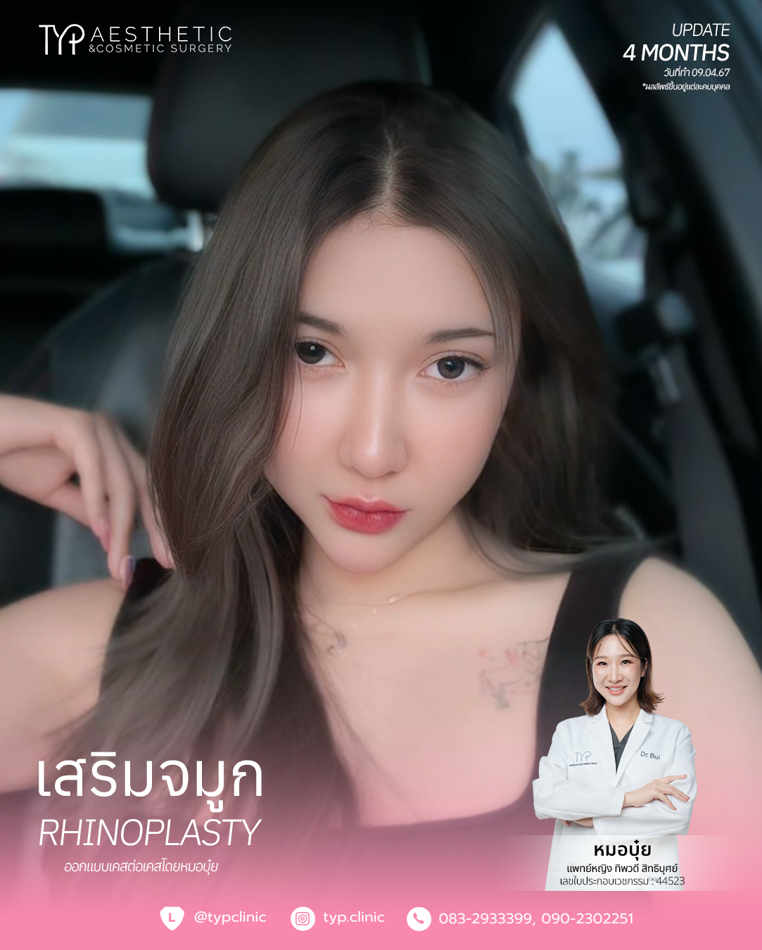 9.4.67-2 เสริมจมูก