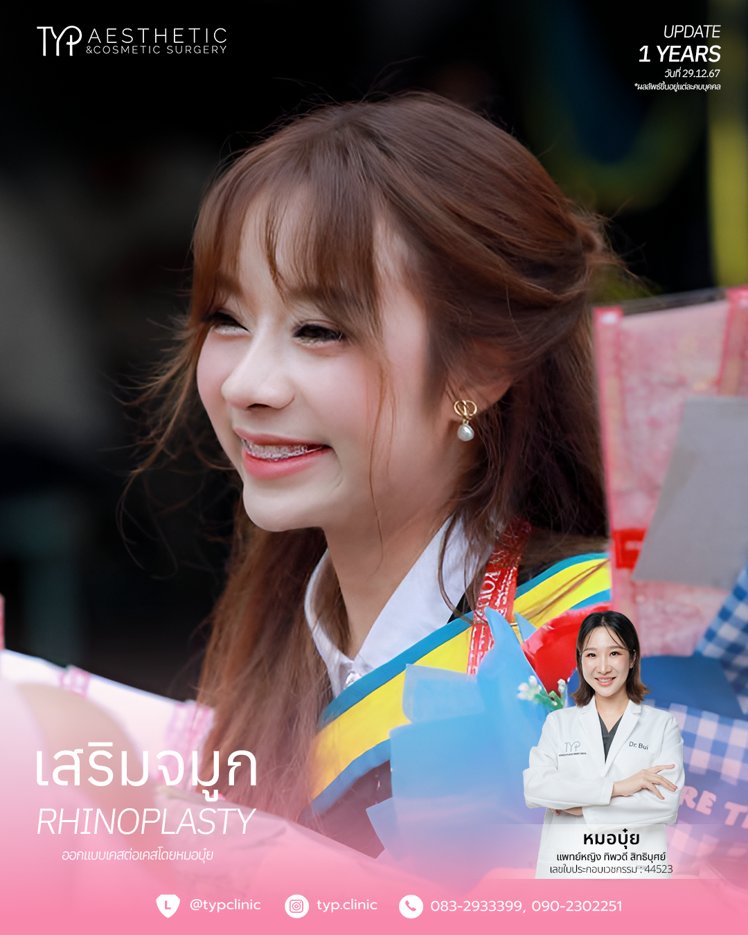 เสริมจมูก