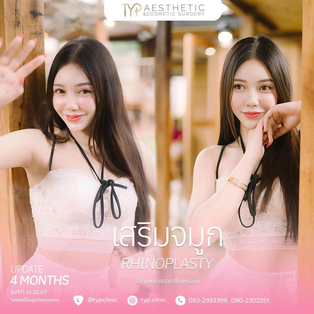 รีวิว – จมูก – 8 เสริมจมูก