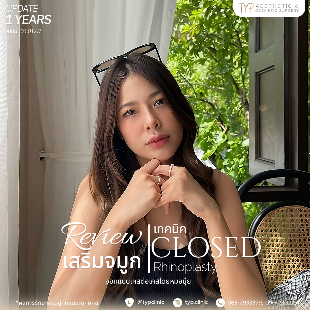 รีวิวเสริมจมูก TYP
