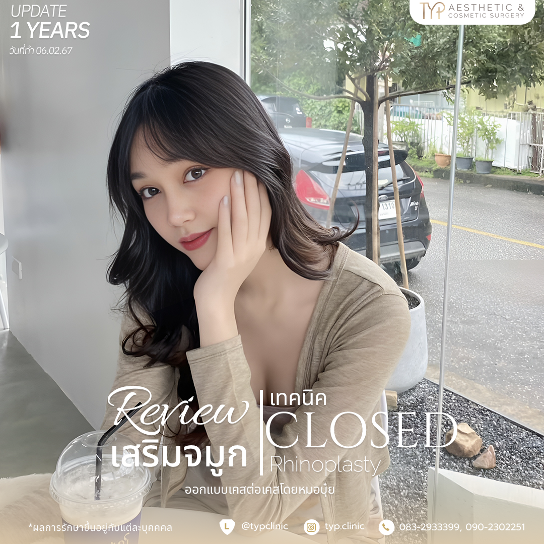 รีวิวเสริมจมูก TYP