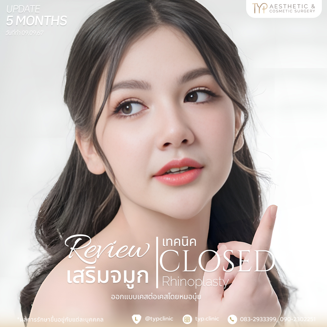 รีวิวเสริมจมูก TYP