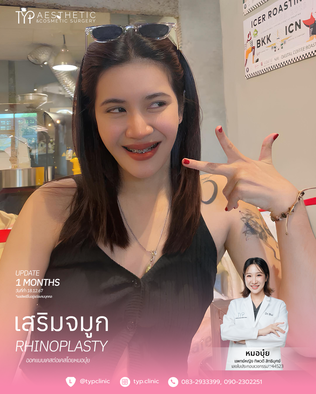 18.12.67 เสริมจมูก