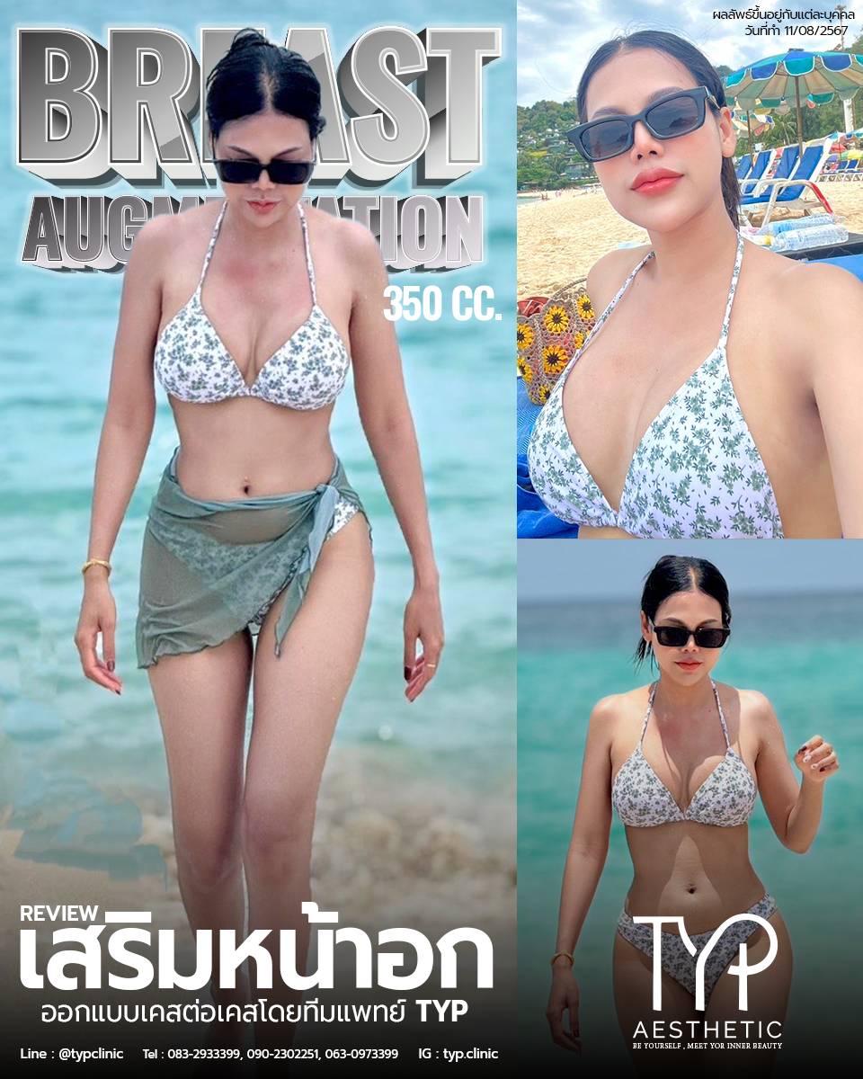 เสริมหน้าอก - TYP