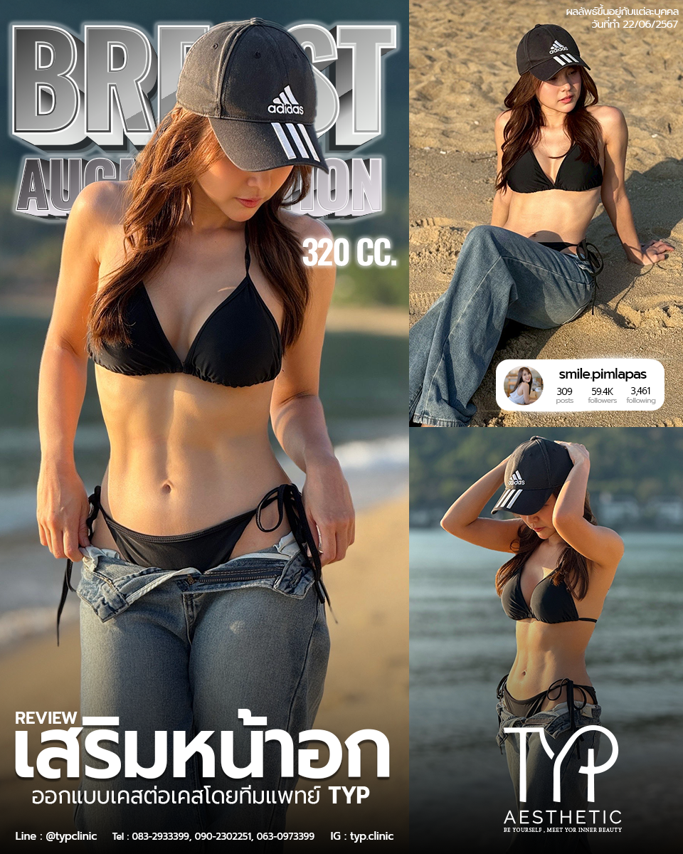 เสริมหน้าอก TYP