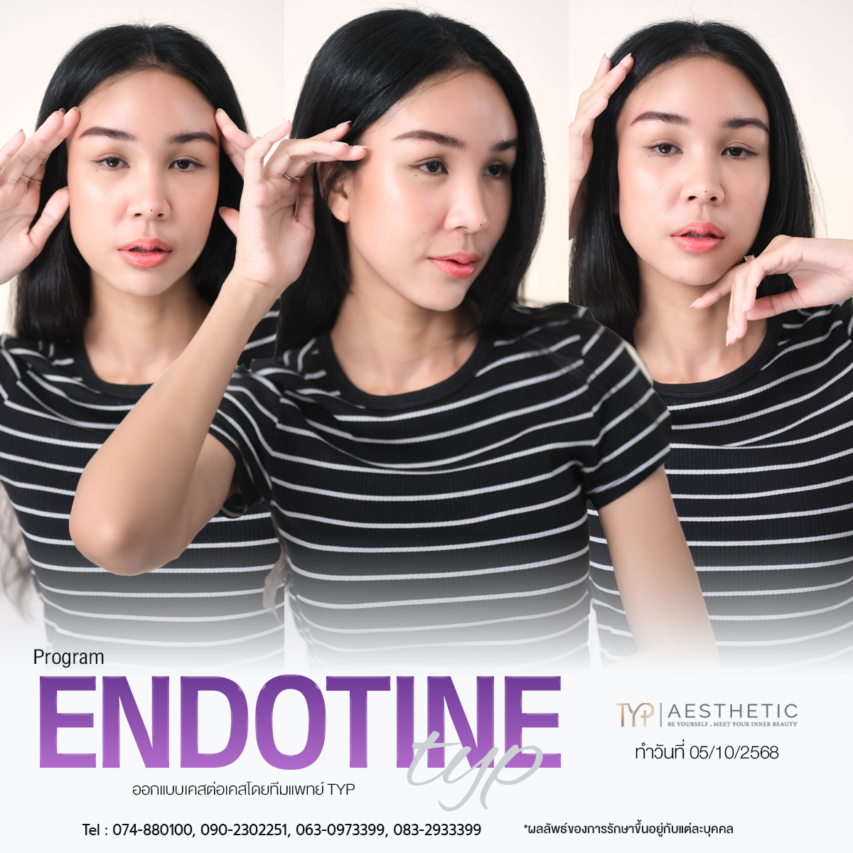 รีวิว Endotine TYP Hospital