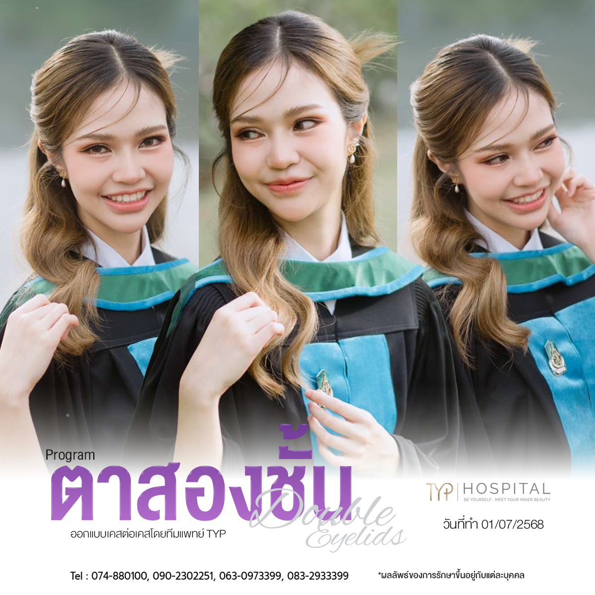 รีวิวตาสองชั้น TYP Hospital