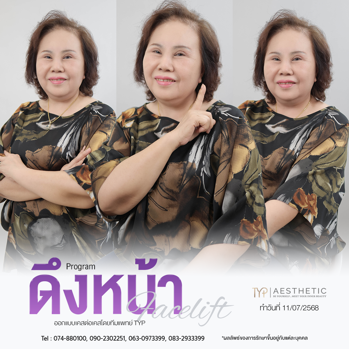 รีวิว ดึงหน้า TYP Hospital