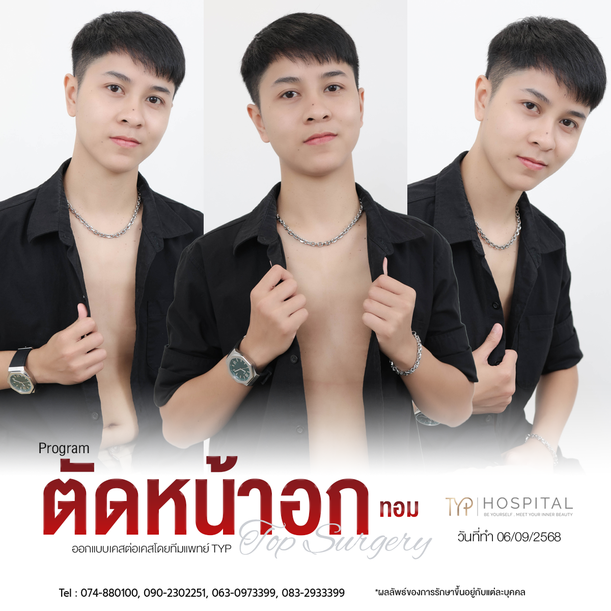 รีวิว ตัดหน้าอก TYP Hospital