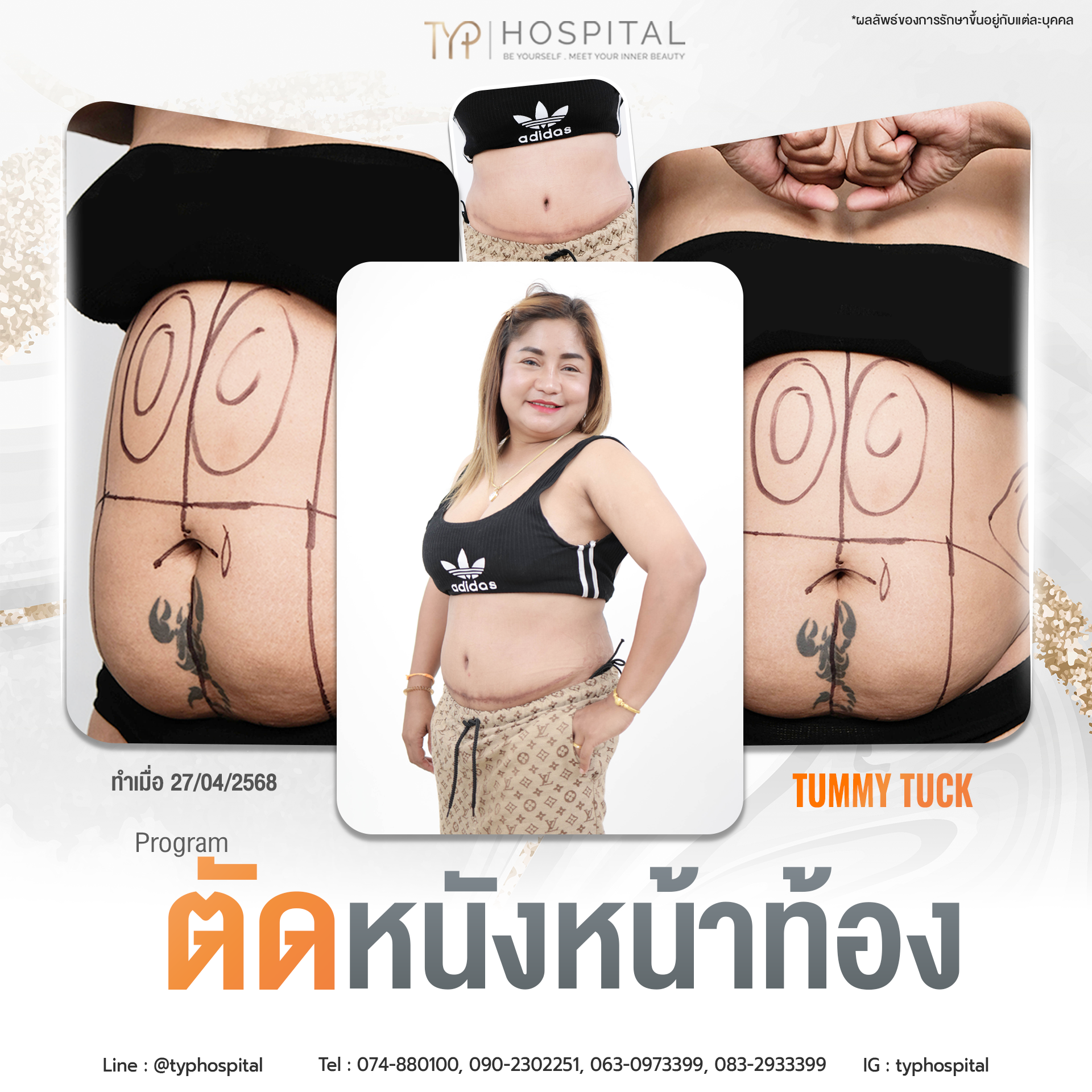 รีวิวตัดหนังหน้าท้อง TYP Hospital