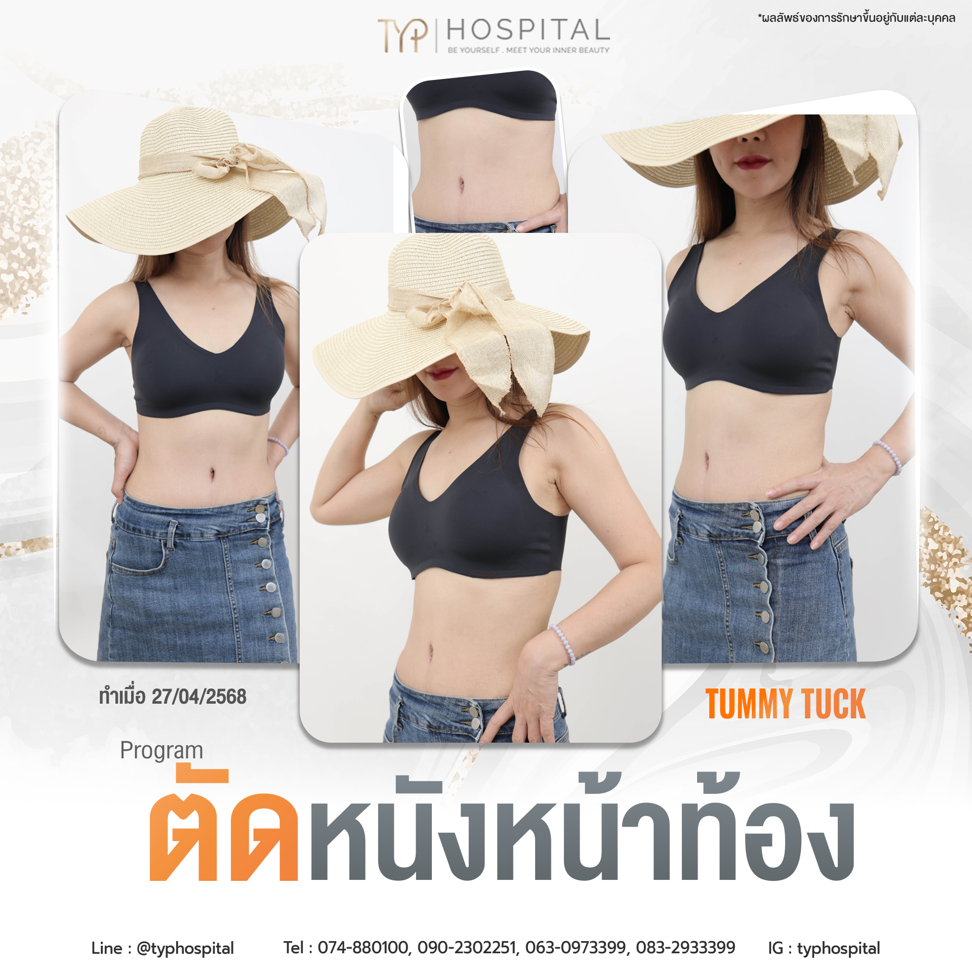 รีวิวตัดหนังหน้าท้อง TYP Hospital