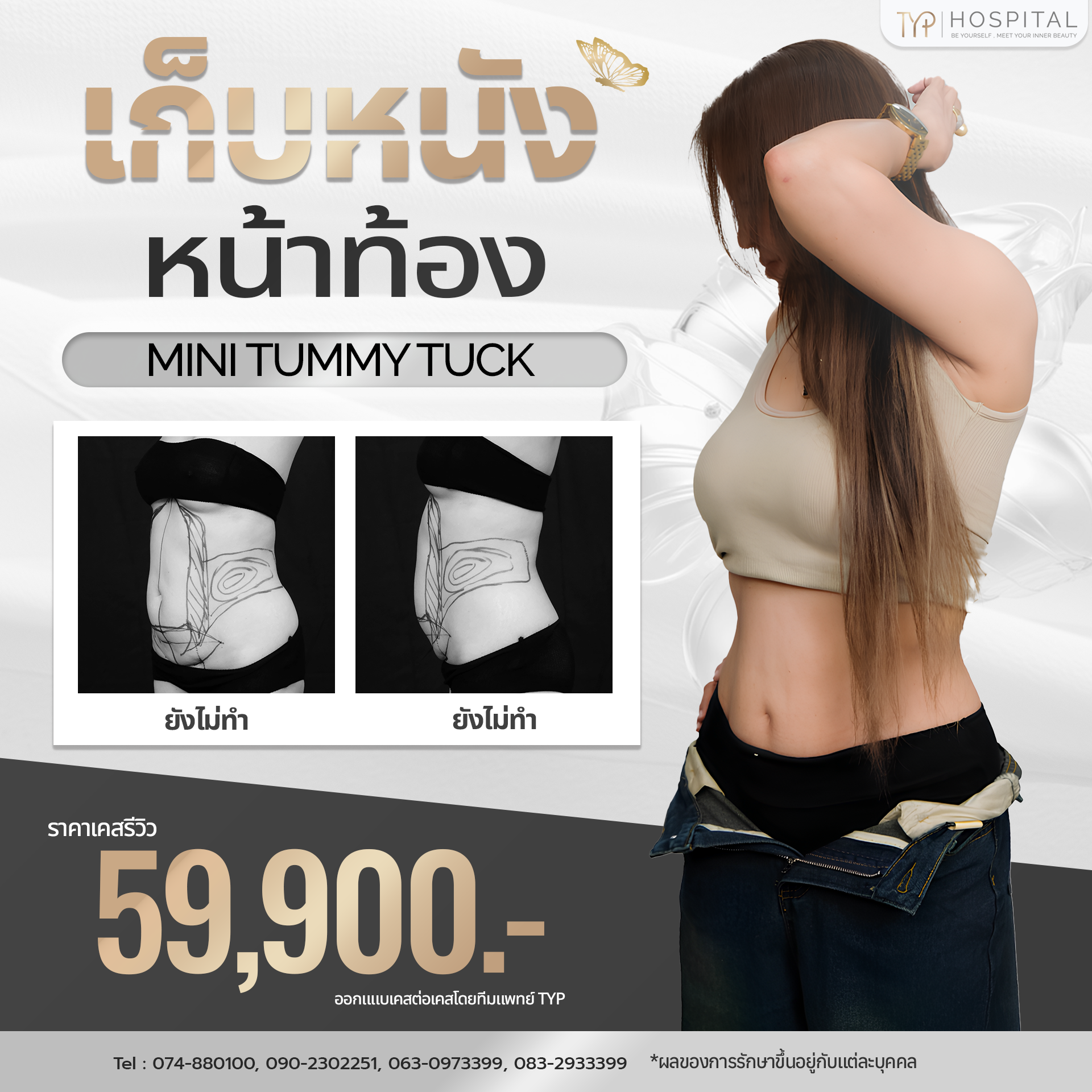 ตัดหนังหน้าท้อง TYP Hospital