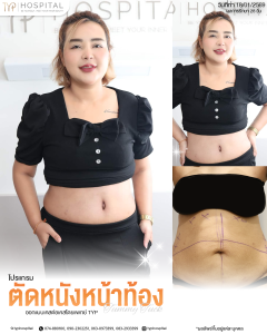 รีวิวตัดหนังหน้าท้อง Tummy Tuck TYP Hospital