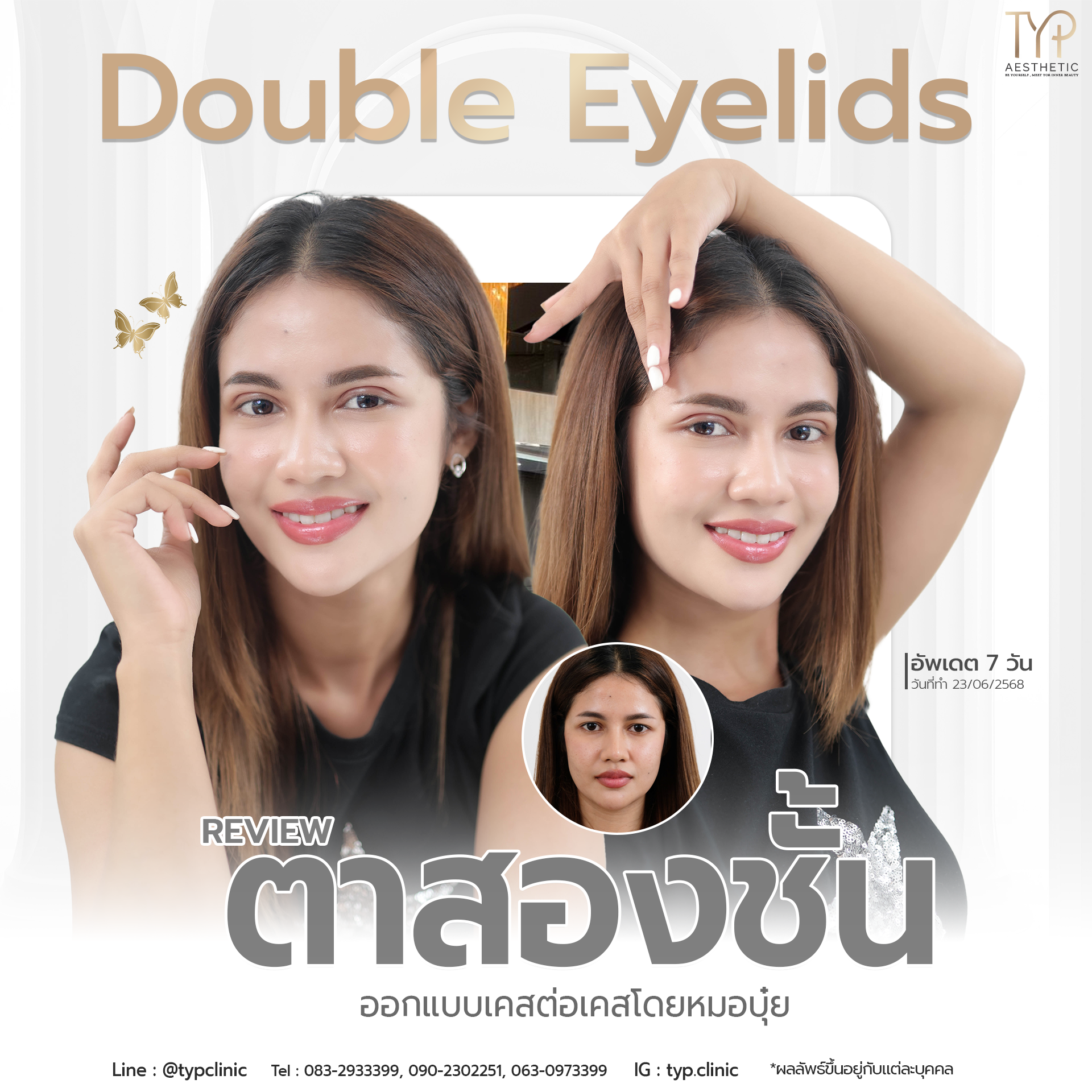 รีวิวตาสองชั้น TYP Hospital