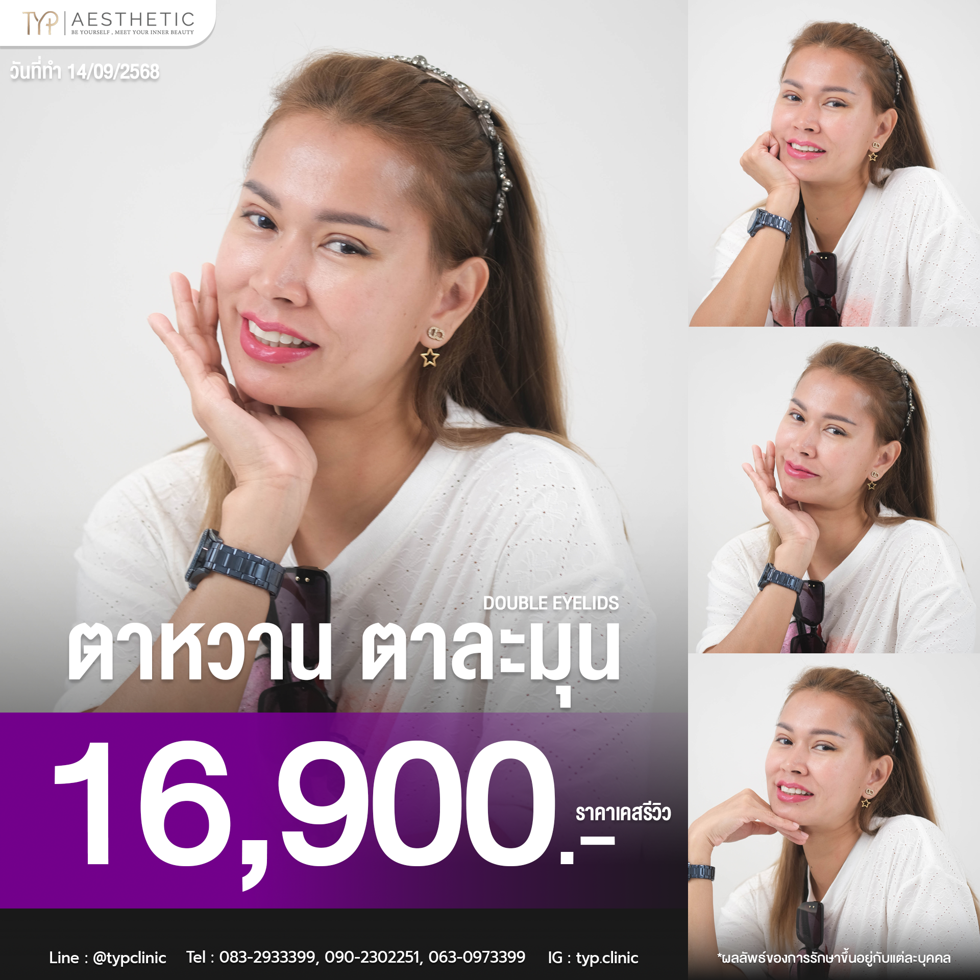 รีวิวตาสองชั้น TYP Hospital