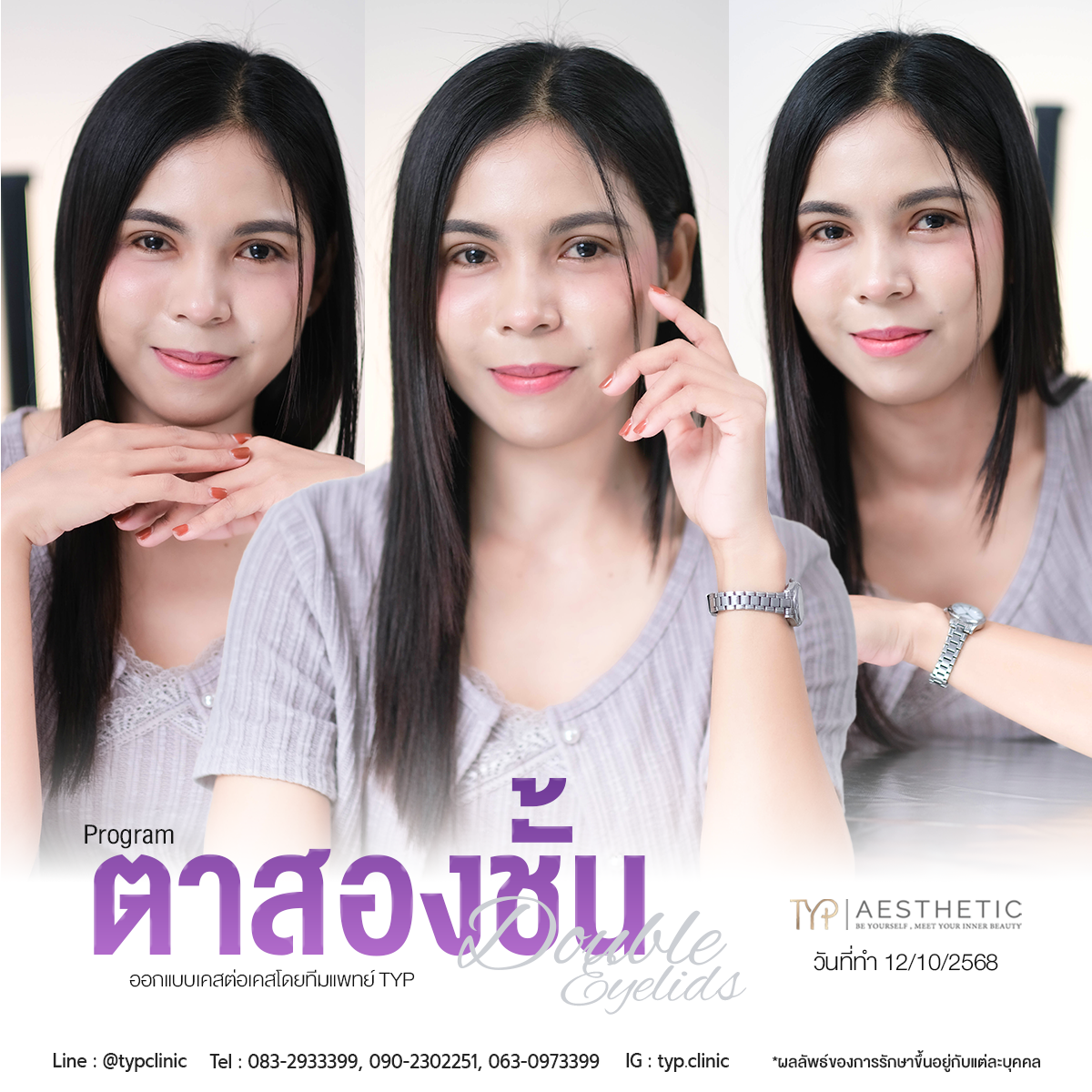 รีวิวตาสองชั้น TYP Hospital