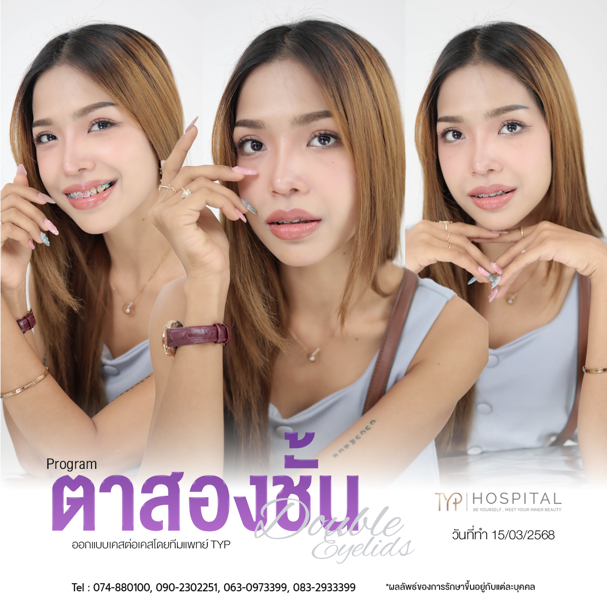 รีวิวตาสองชั้น TYP Hospital