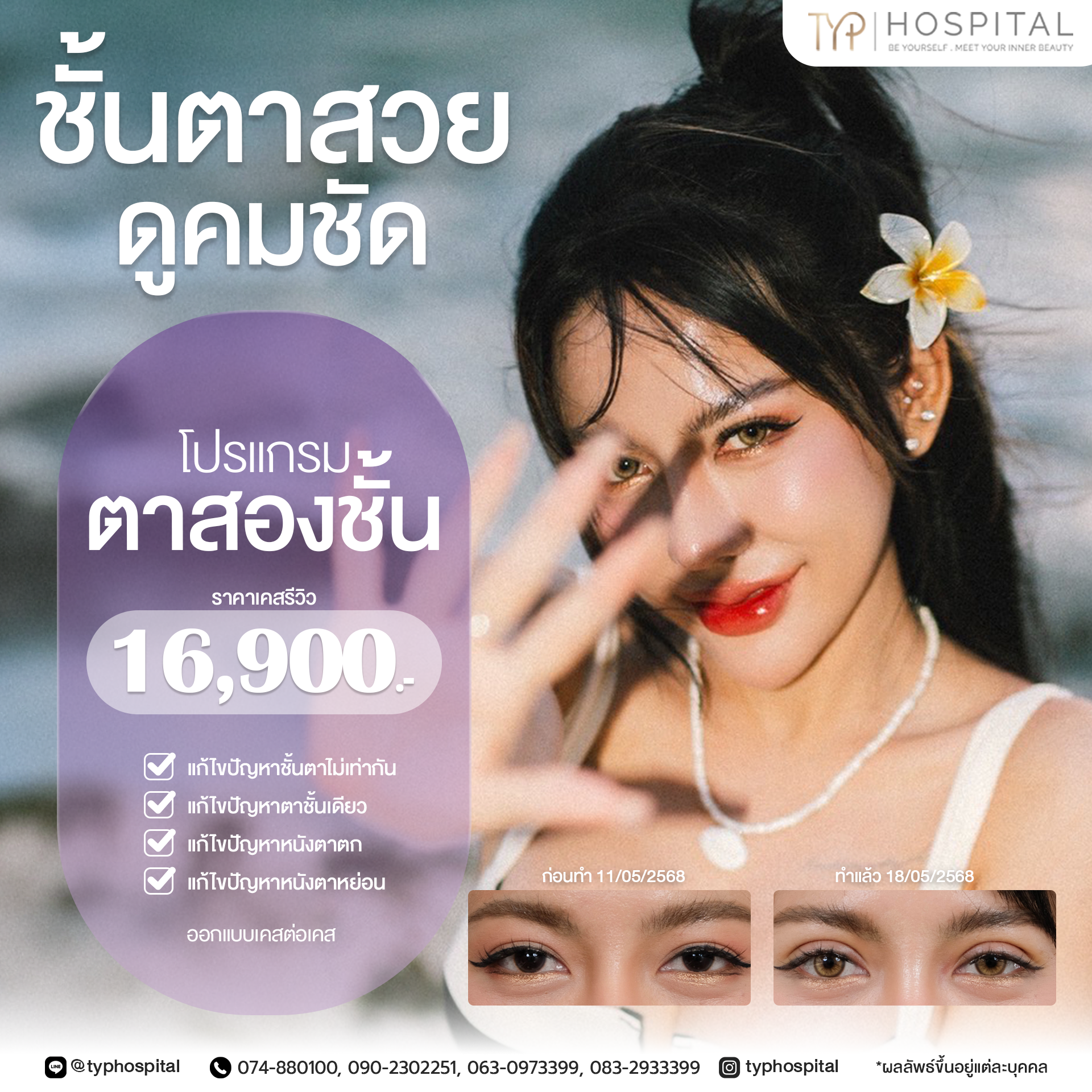 ตาสองชั้นรีวิว TYP Hospital
