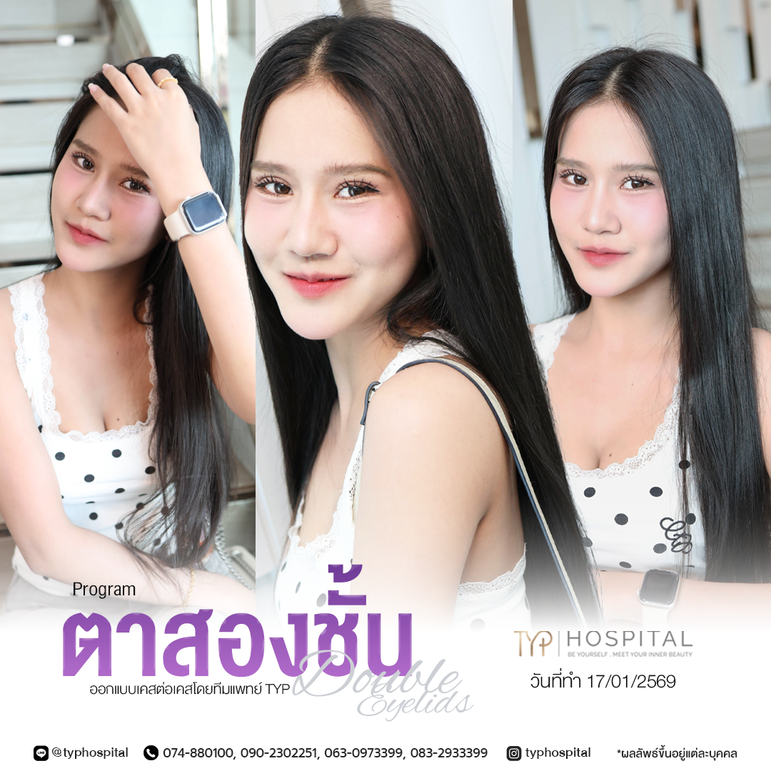 ตาสองชั้น TYP Hospital