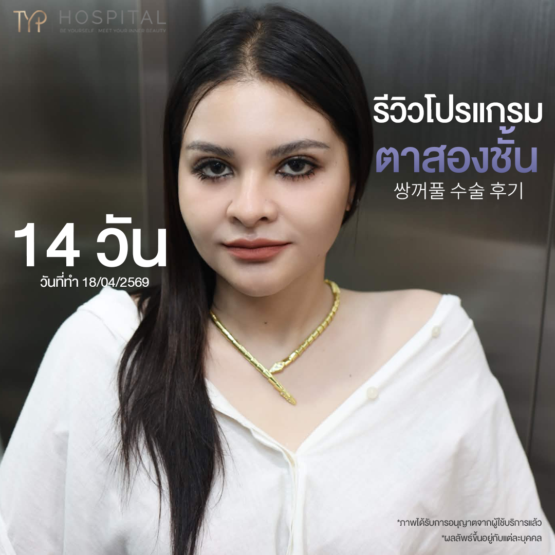 รีวิวตาสองชั้น TYP Hospital
