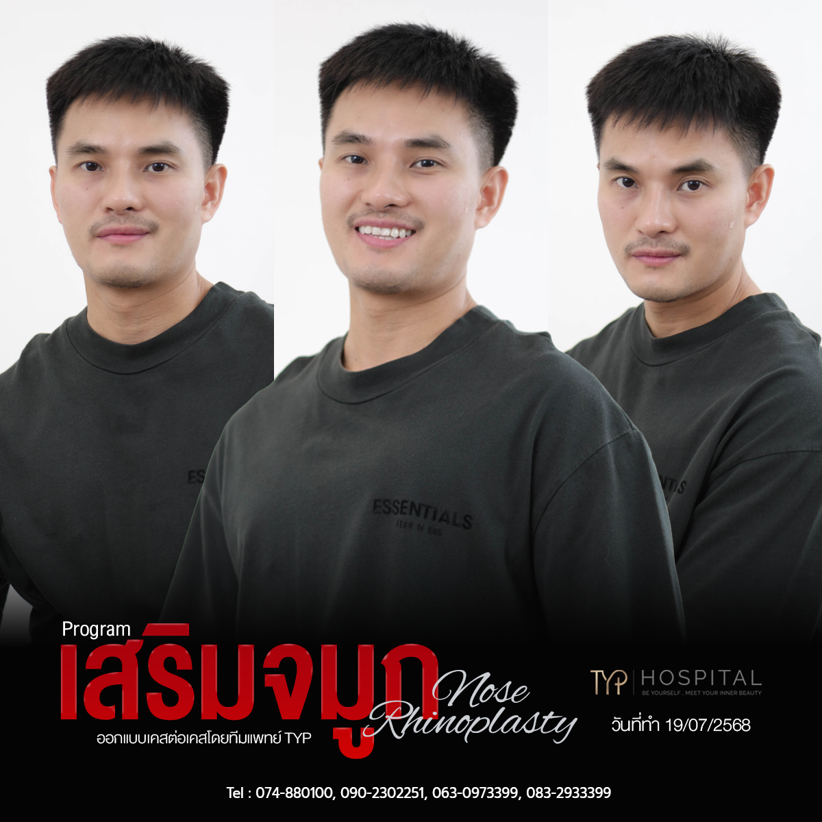 รีวิวจมูก TYP Hospital