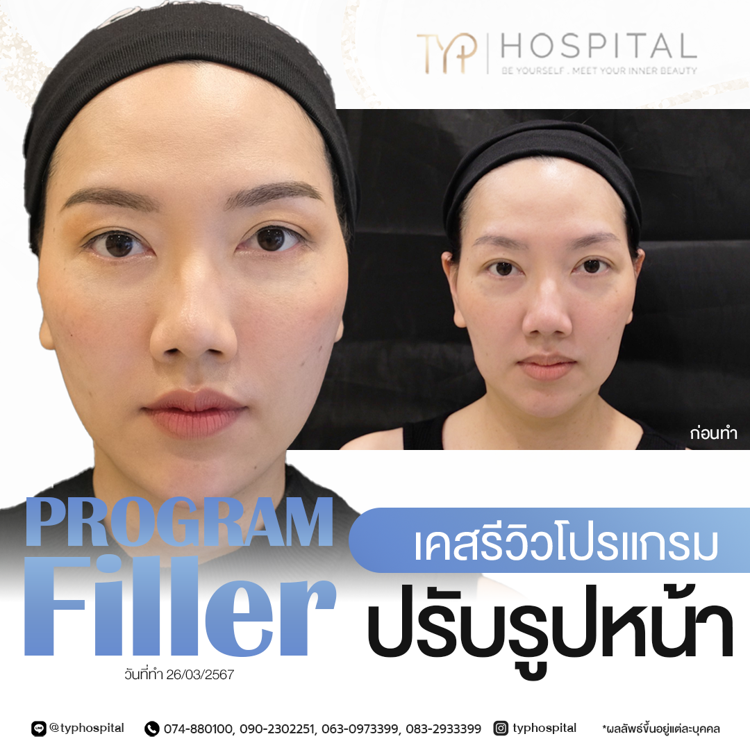รีวิวฟิลเลอร์ TYP Hospital