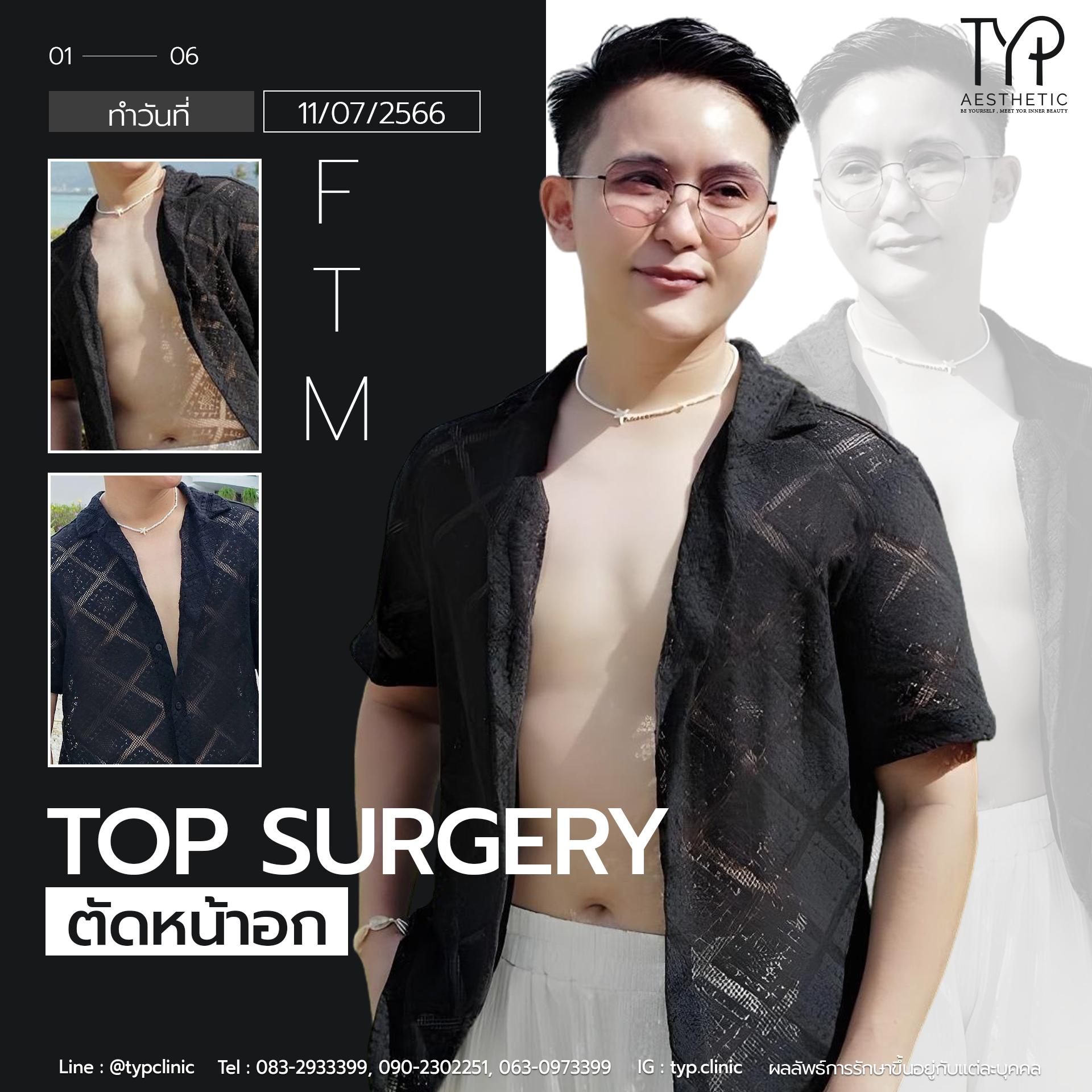 รีวิวตัดหน้าอก - TYP Hospital