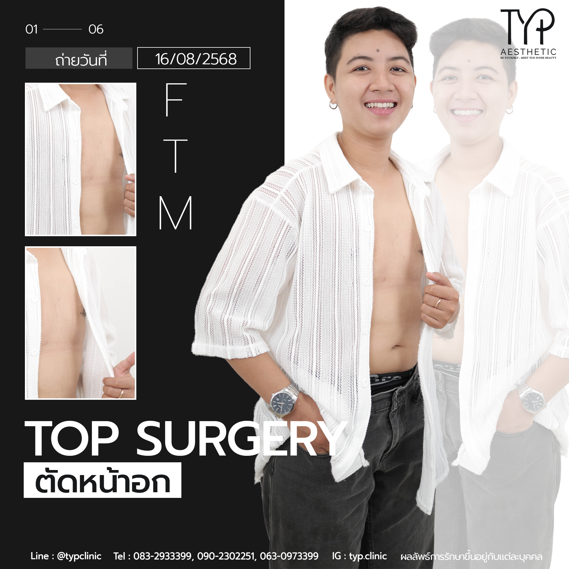 รีวิวตัดหน้าอก - TYP Hospital