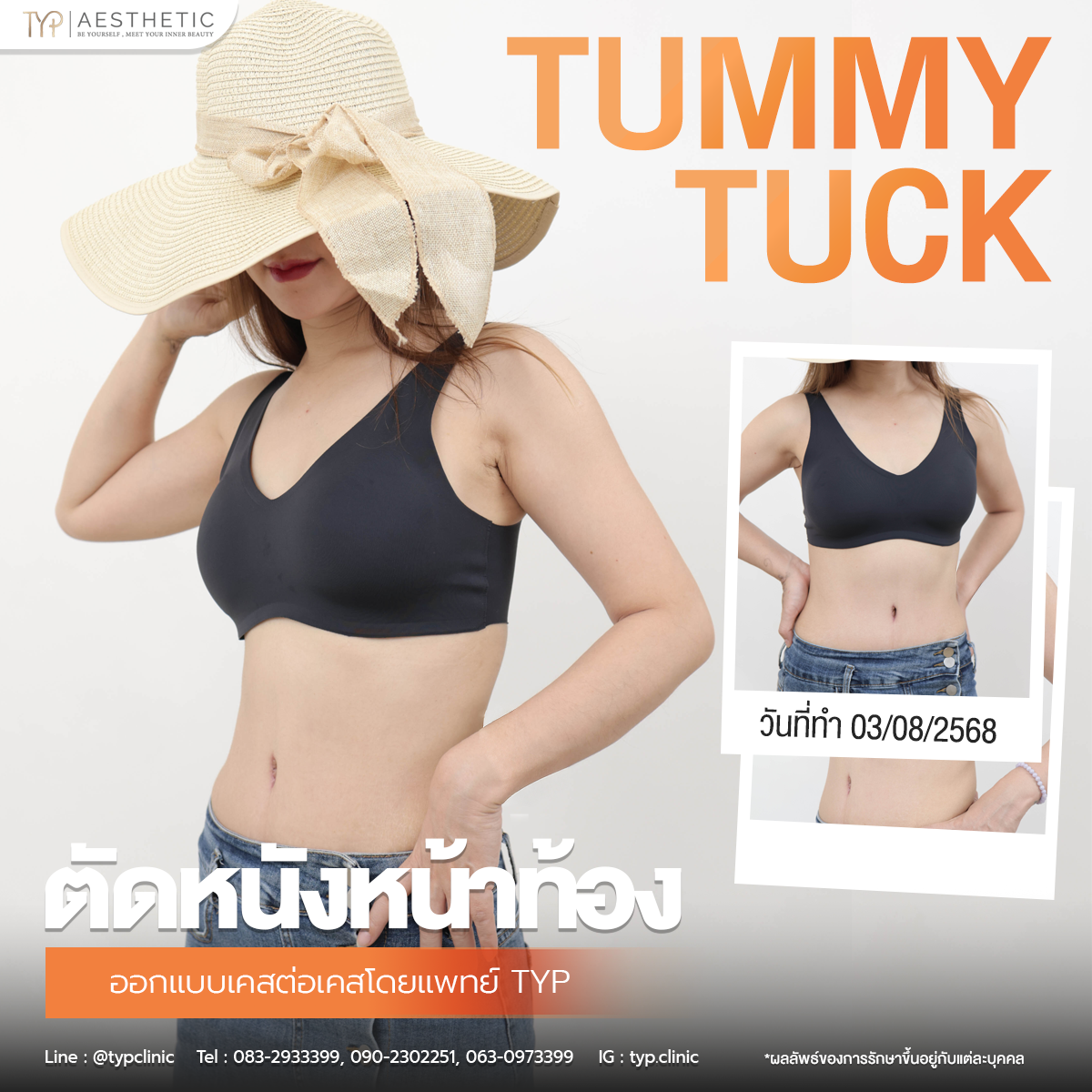 รีวิวตัดหนังหน้าท้อง TYP Hospital