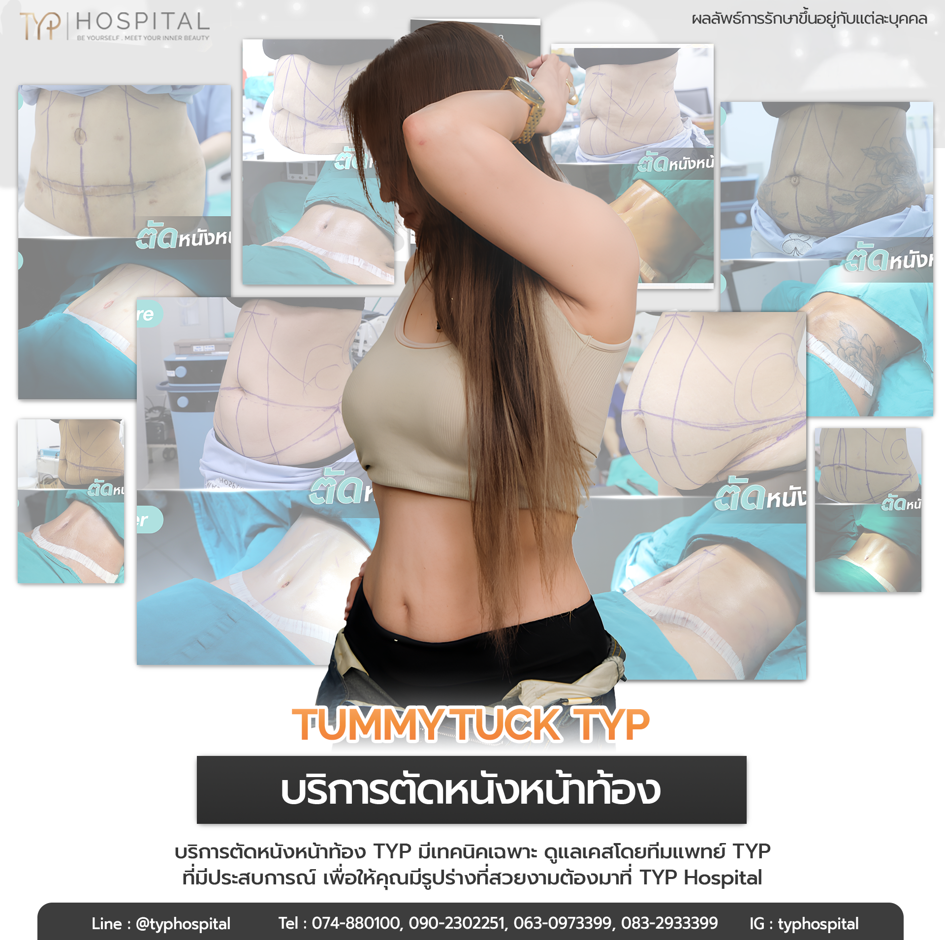 รีวิวตัดหนังหน้าท้อง TYP Hospital
