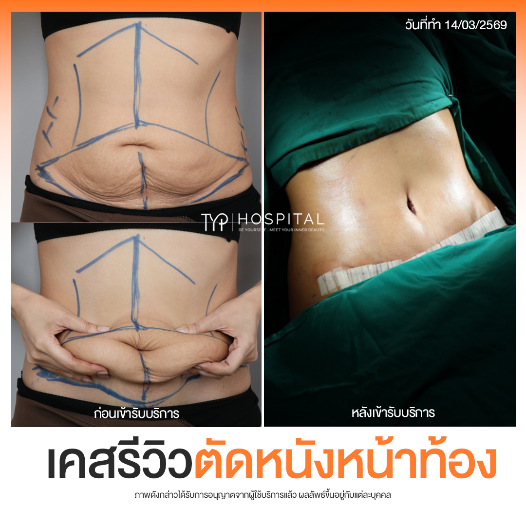 รีวิวตัดหนังหน้าท้อง TYP Hospital
