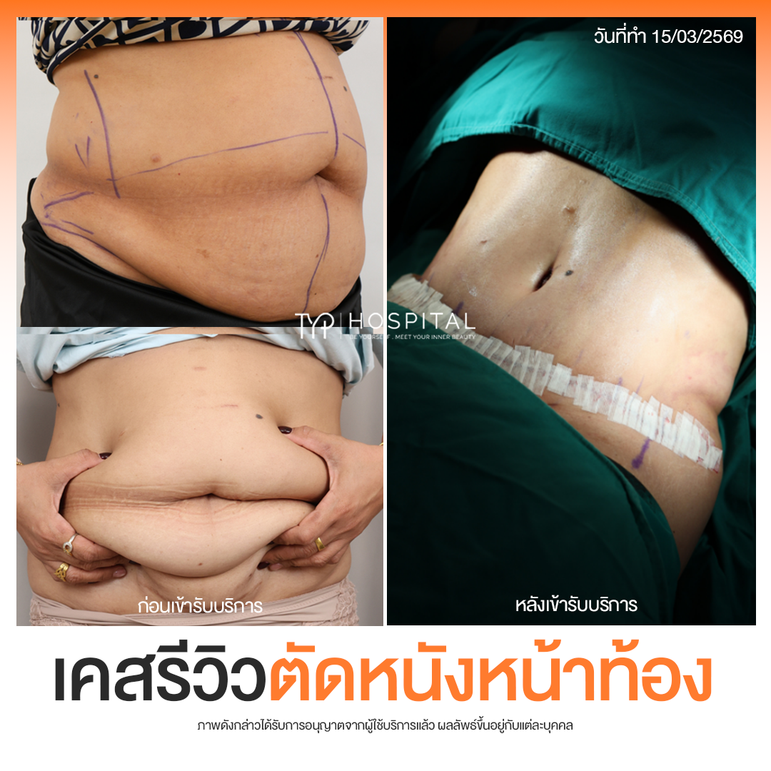 รีวิวตัดหนังหน้าท้อง TYP Hospital
