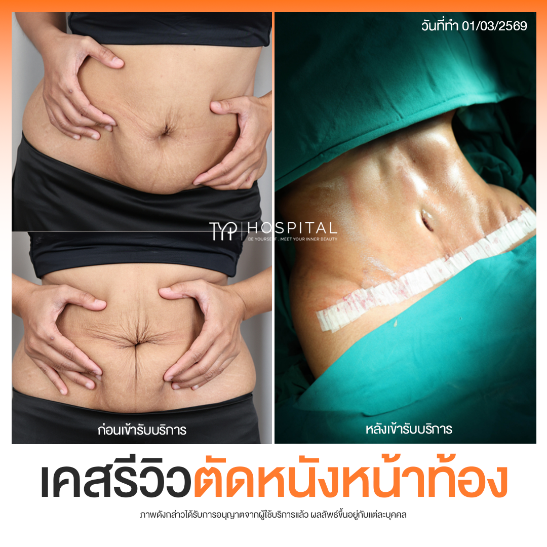 รีวิวตัดหนังหน้าท้อง TYP Hospital