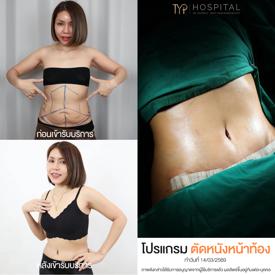 รีวิวตัดหนังหน้าท้อง TYP Hospital