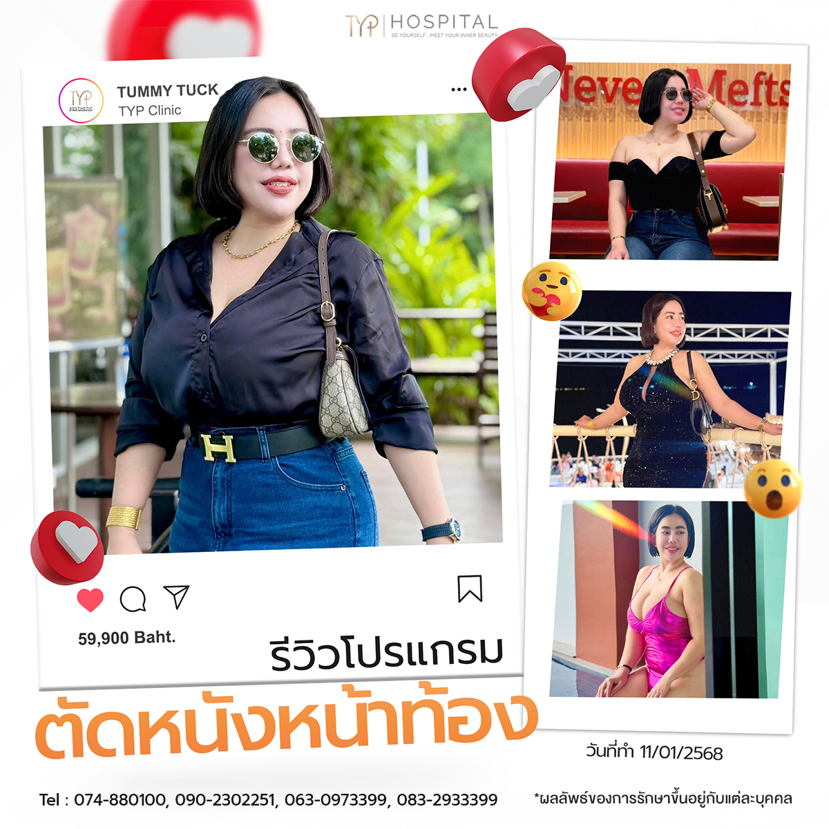 รีวิวตัดหนังหน้าท้อง TYP Hospital