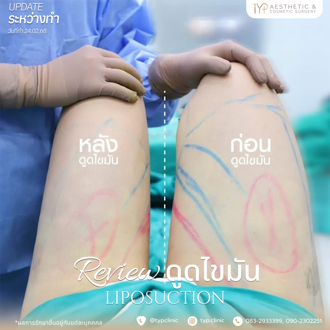 รีวิวดูดไขมัน TYP Hospital
