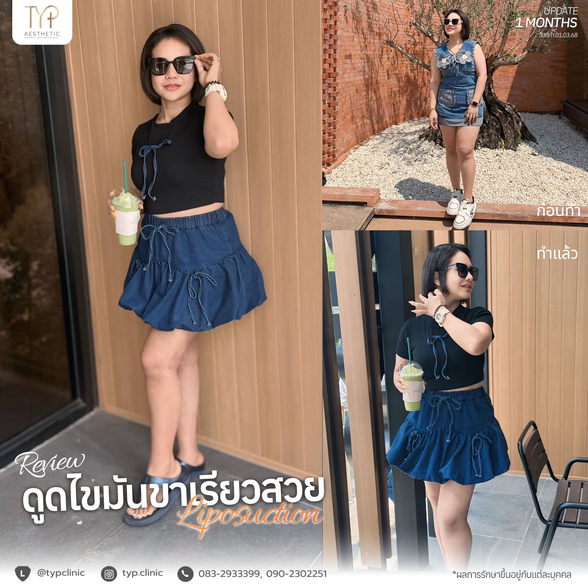 รีวิวดูดไขมัน TYP Hospital