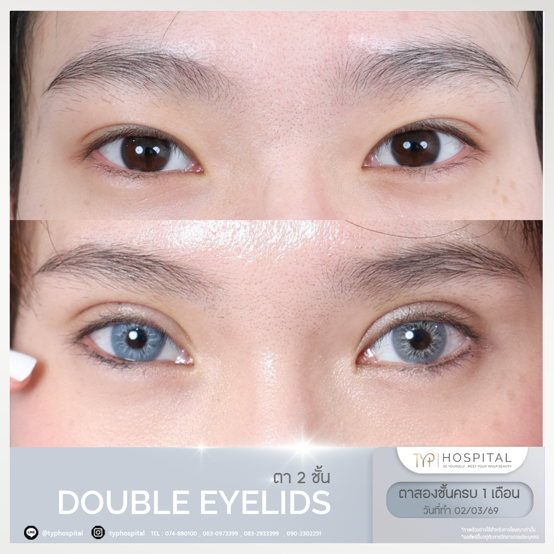 รีวิวตาสองชั้น - TYP Hospital