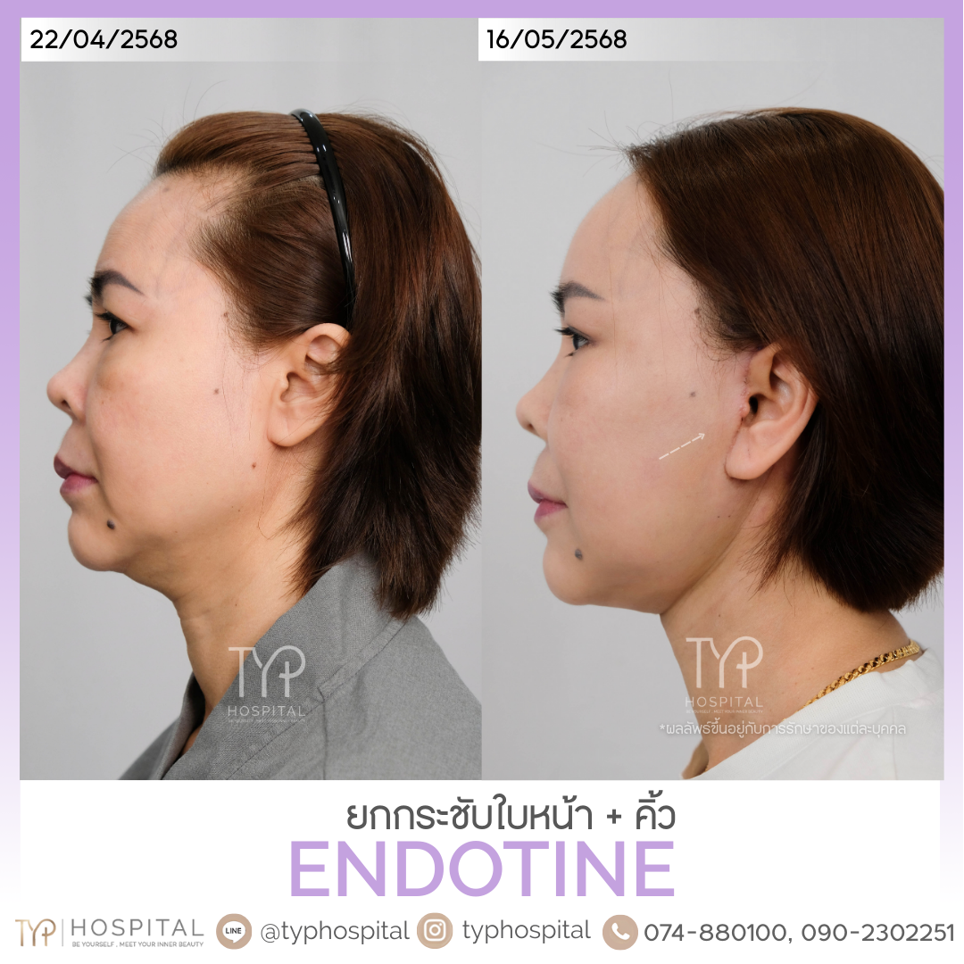 รีวิวดึงหน้า - TYP Hospital