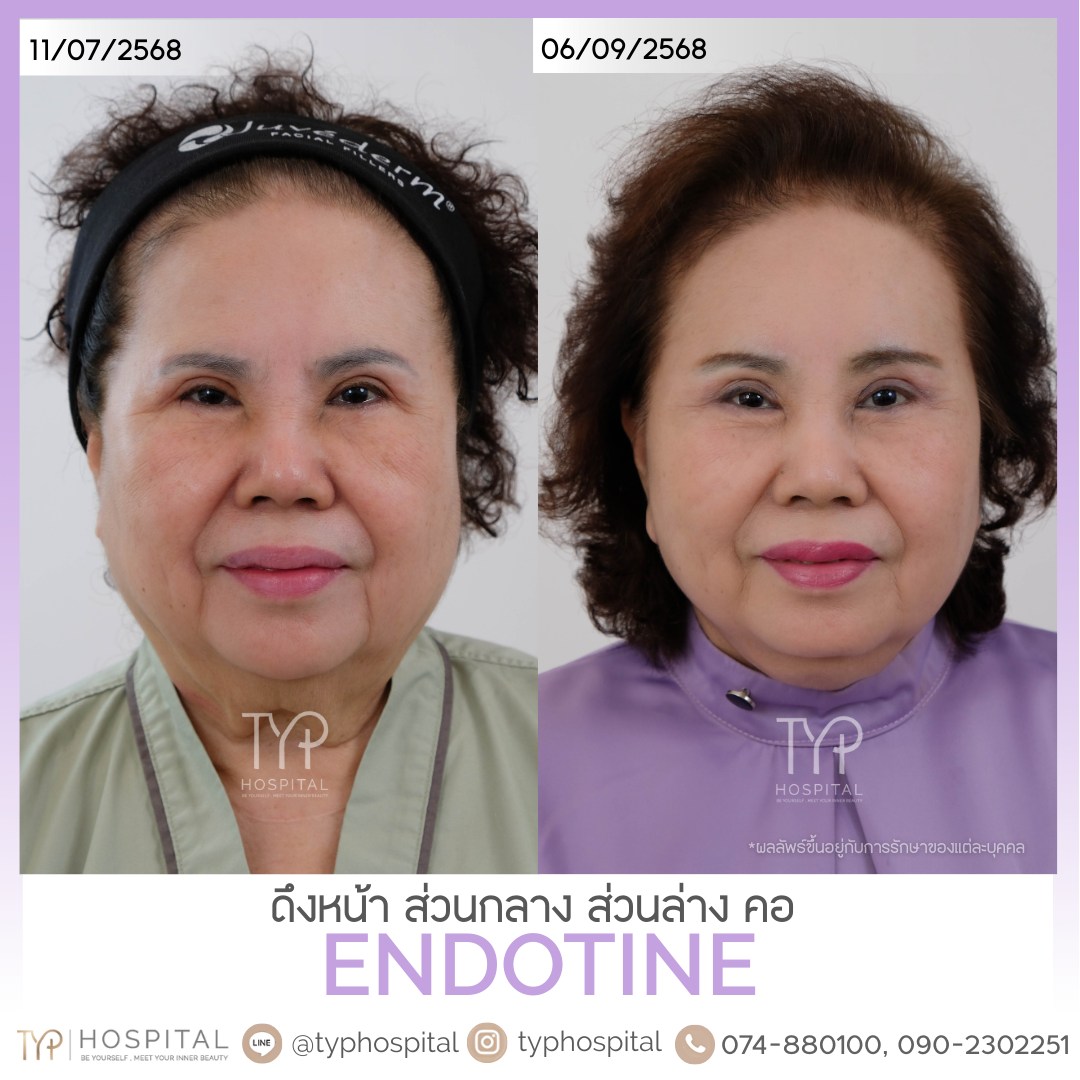 รีวิวดึงหน้า - TYP Hospital