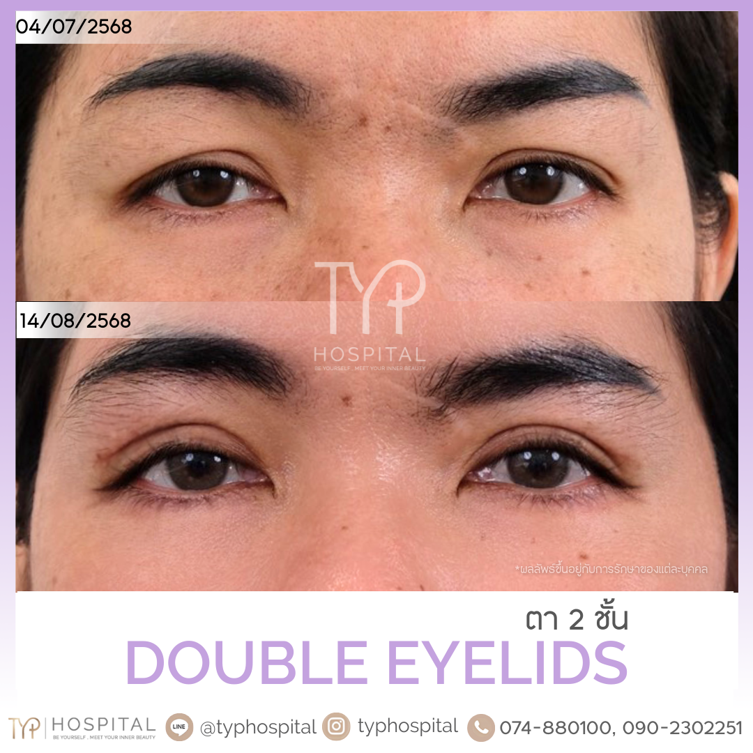 รีวิวตาสองชั้น - TYP Hospital