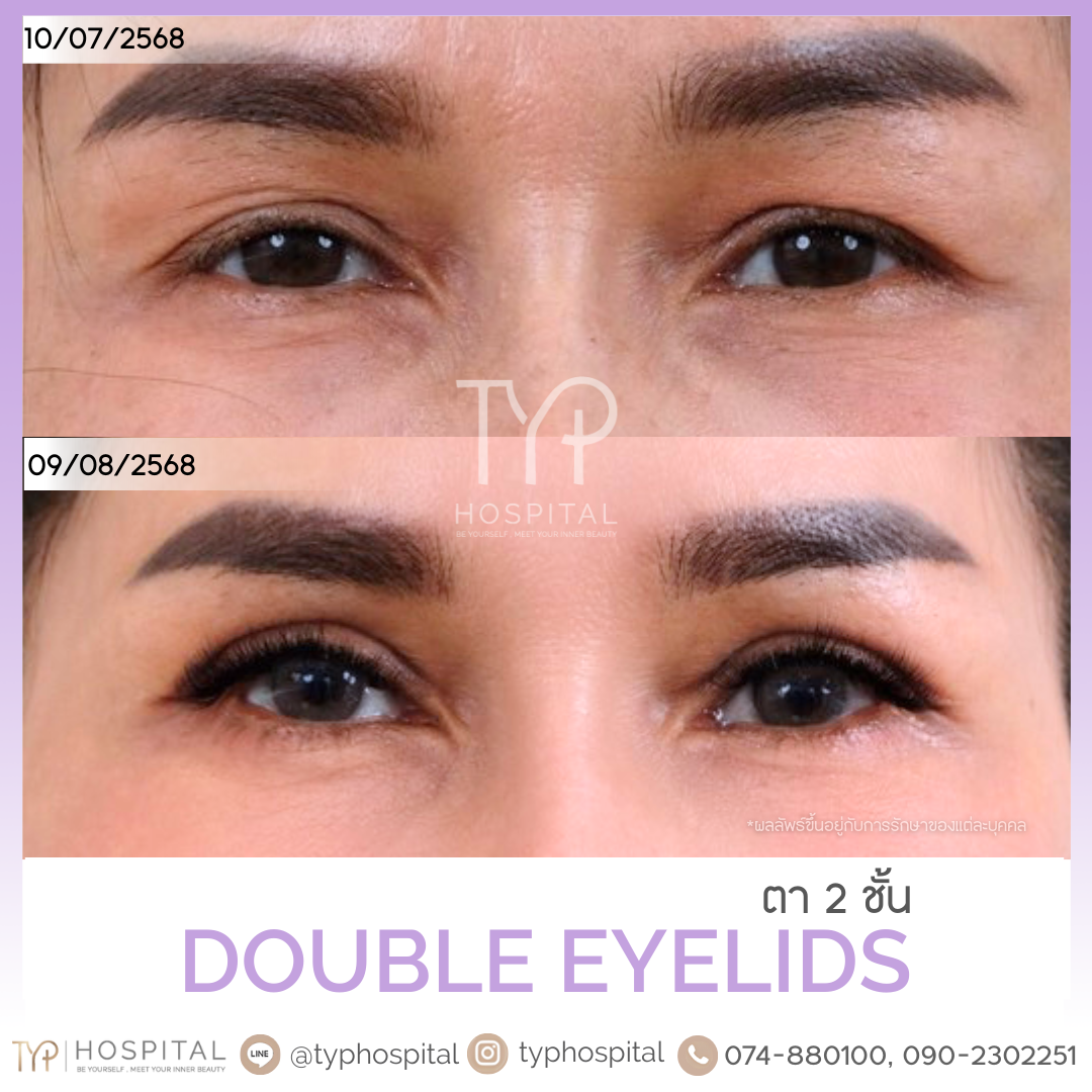 รีวิวตาสองชั้น - TYP Hospital