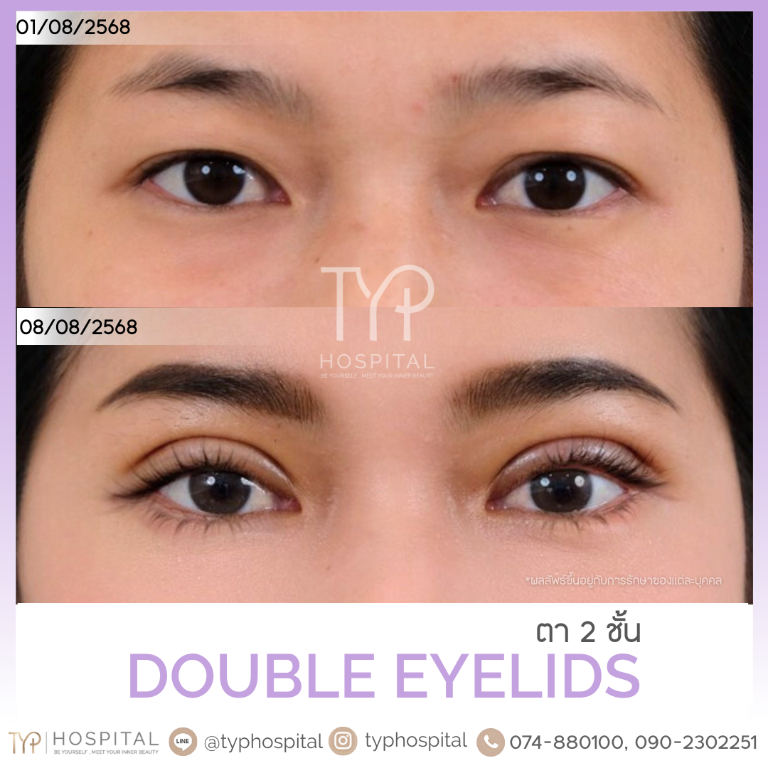 รีวิวตาสองชั้น - TYP Hospital