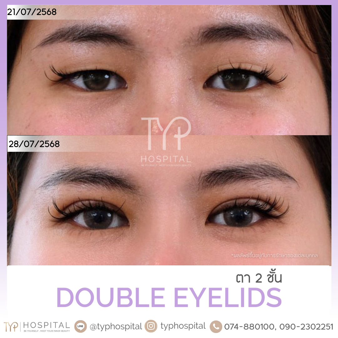 รีวิวตาสองชั้น - TYP Hospital