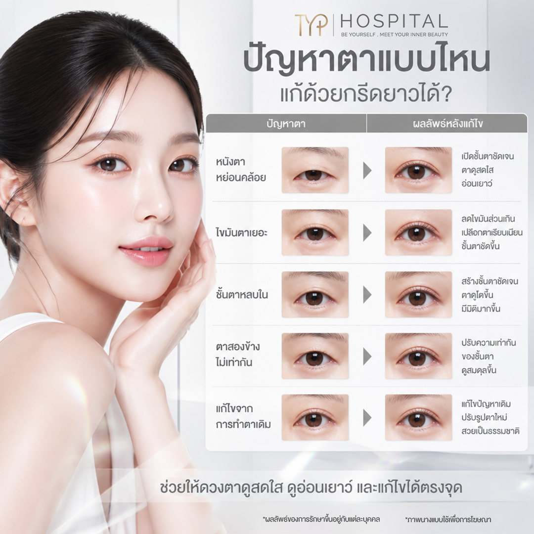 ปัญหาแบบไหนแก้ด้วยตาสองชั้นกรีดยาวได้ – TYP Hospital ปัญหาแบบไหนแก้ด้วยตาสองชั้นกรีดยาวได้ - TYP Hospital