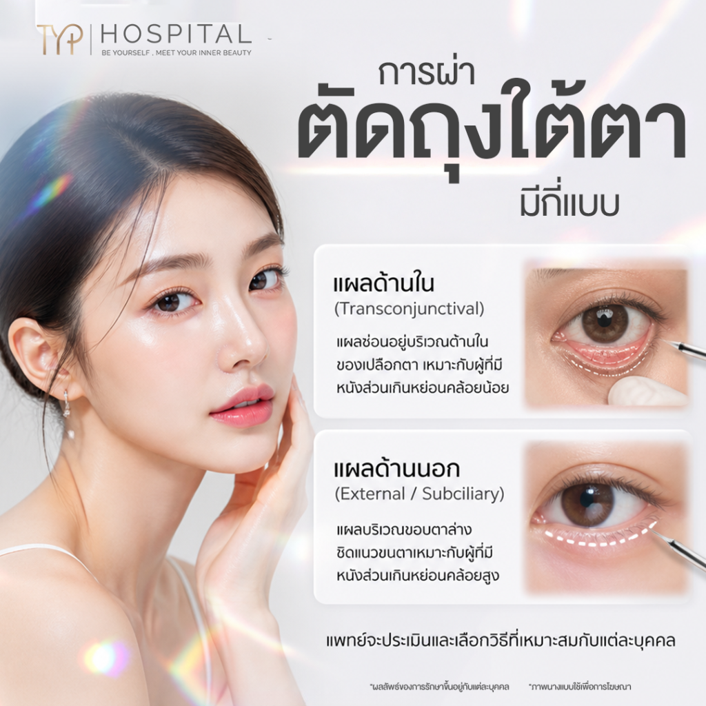 ถุงใต้ตา 4 การตัดถุงใต้ตามีกี่แบบ - TYP Hospital