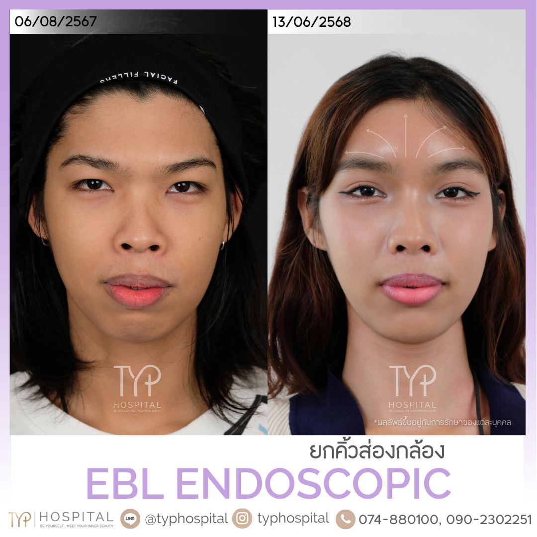 รีวิวยกคิ้ว EBL - TYP HOSPITAL