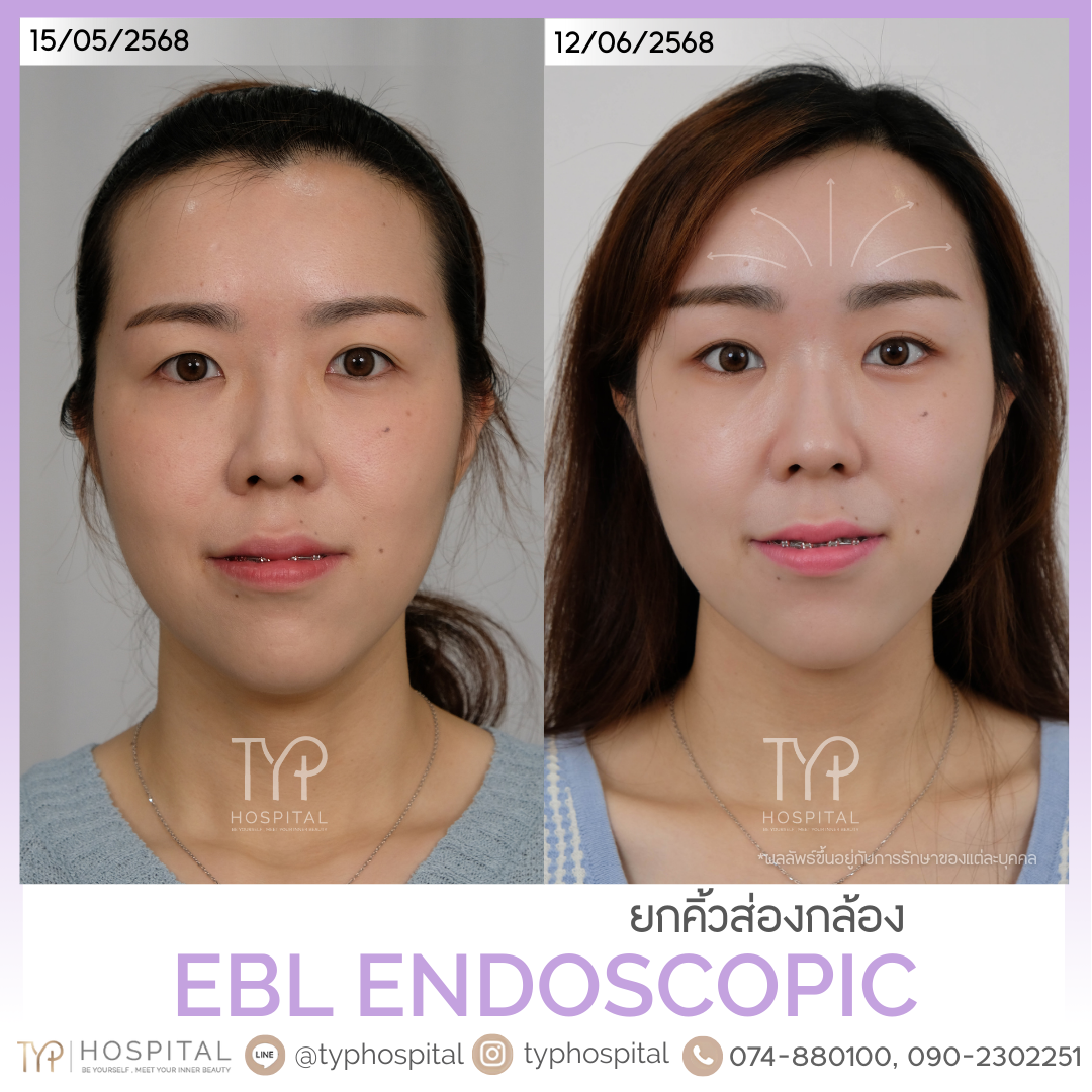 รีวิวยกคิ้ว EBL - TYP HOSPITAL
