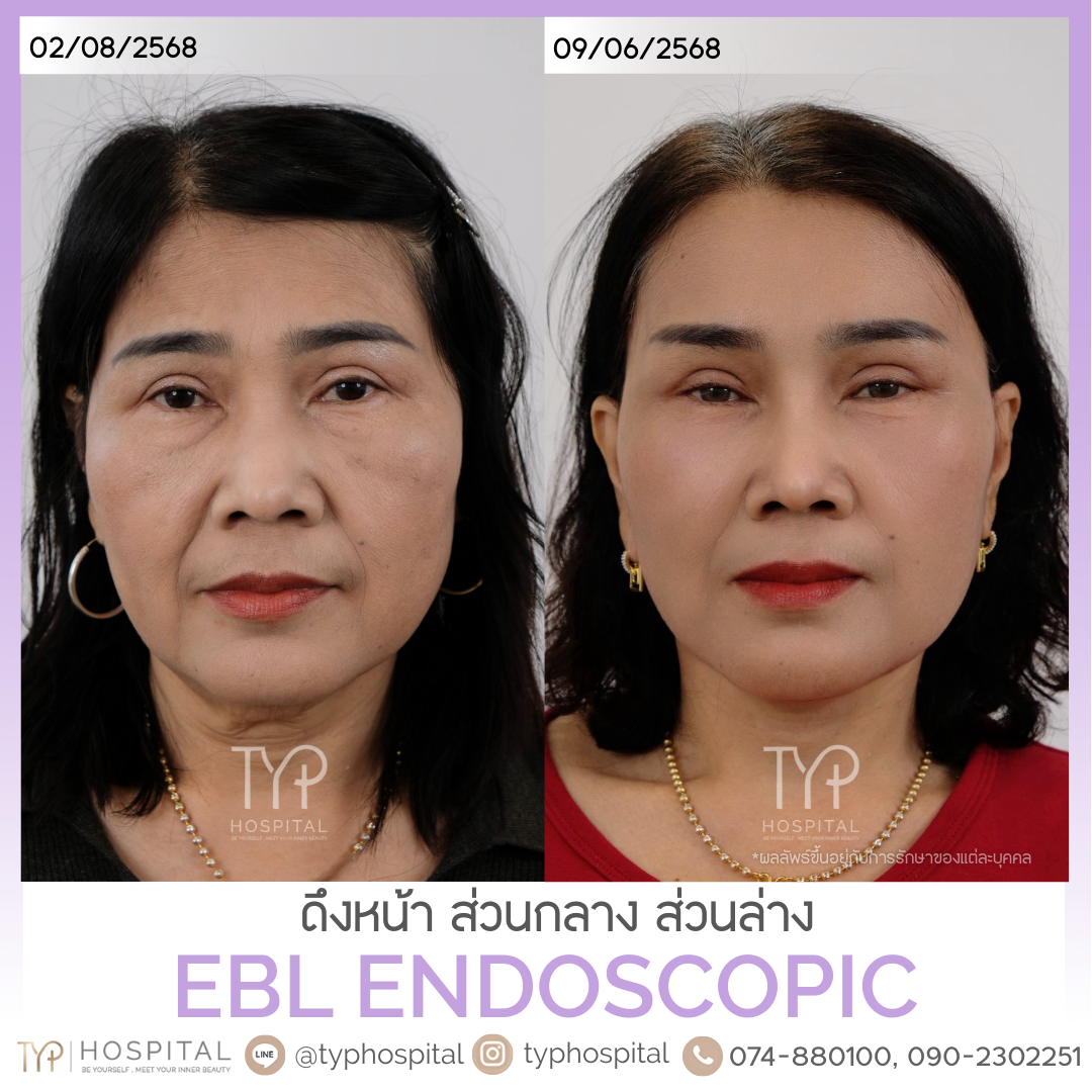 รีวิวยกคิ้ว EBL - TYP HOSPITAL